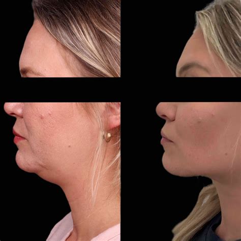 buccal fat removal pris